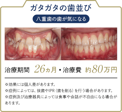 ガタガタの歯並び 八重歯が気になる治療期間:26ヵ月 治療費:約80万円 ※効果には個人差があります。※症例によっては、抜歯やIPR（歯を削る）を行う場合があります。※症例及び治療器具によっては食事や会話が不自由になる場合があります。