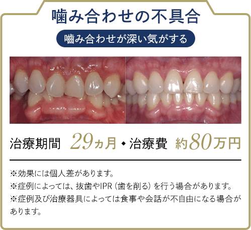 噛み合わせの不具合 嚙み合わせが深い気がする 治療期間:29ヶ月 治療費:約80万円 ※効果には個人差があります。※症例によっては、抜歯やIPR（歯を削る）を行う場合があります。※症例及び治療器具によっては食事や会話が不自由になる場合があります。