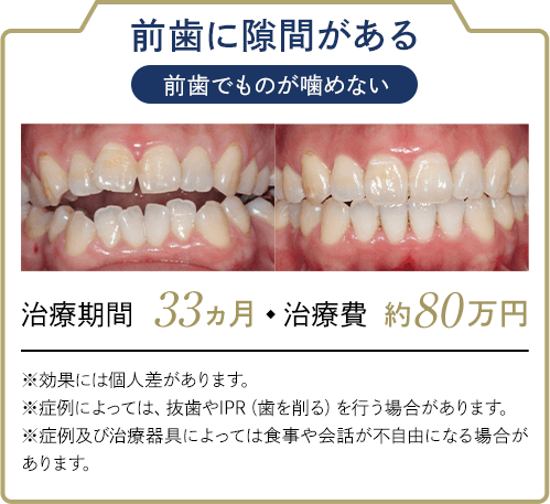 前歯に隙間がある 前⻭でものが噛めない 治療期間:33ヶ月 治療費:約80万円 ※効果には個人差があります。※症例によっては、抜歯やIPR（歯を削る）を行う場合があります。※症例及び治療器具によっては食事や会話が不自由になる場合があります。