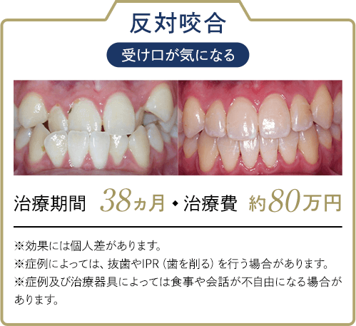 反対咬合 受け口が気になる 治療期間:38ヶ月 治療費:約80万円※効果には個人差があります。※症例によっては、抜歯やIPR（歯を削る）を行う場合があります。※症例及び治療器具によっては食事や会話が不自由になる場合があります。